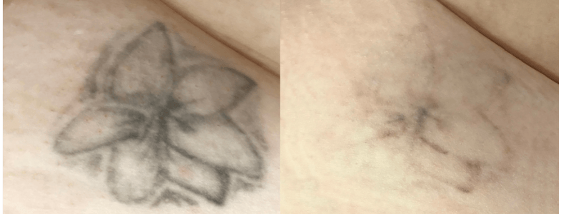 usuwanie-tatuażu-alma-harmony-qswitch